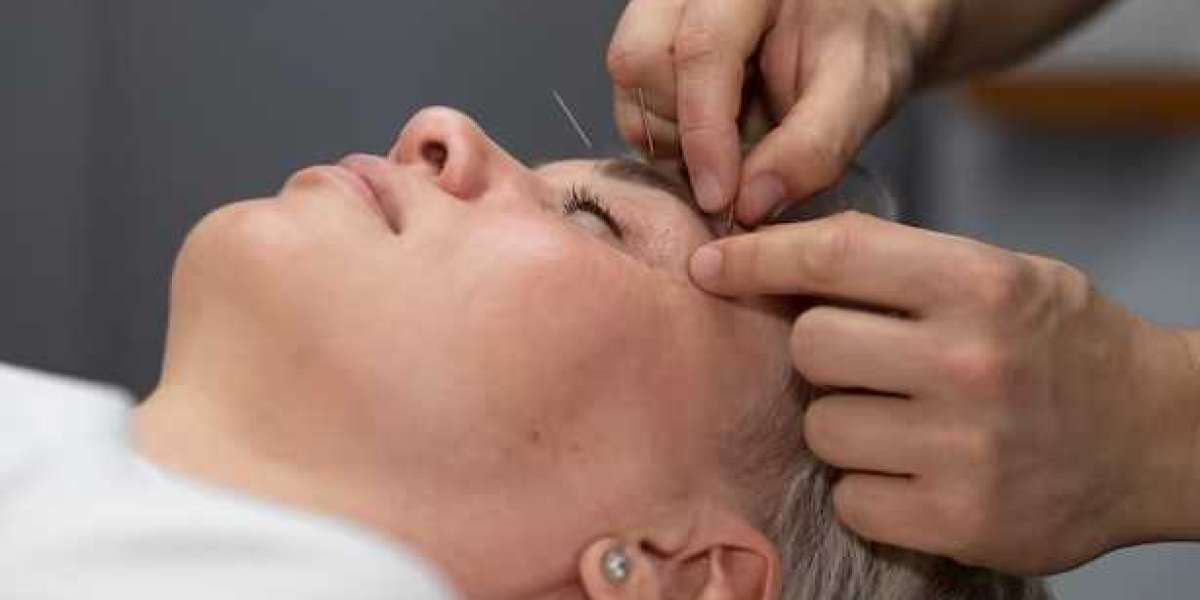 Acupuncture Face Lift in Singapore: Natural Rejuvenation